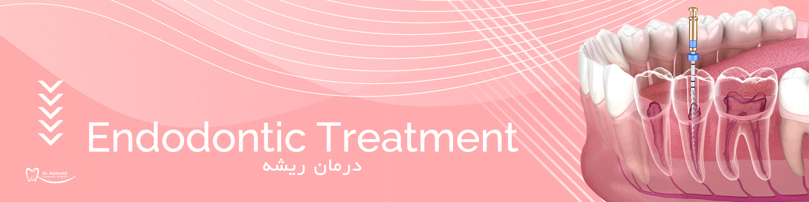 درمان ریشه