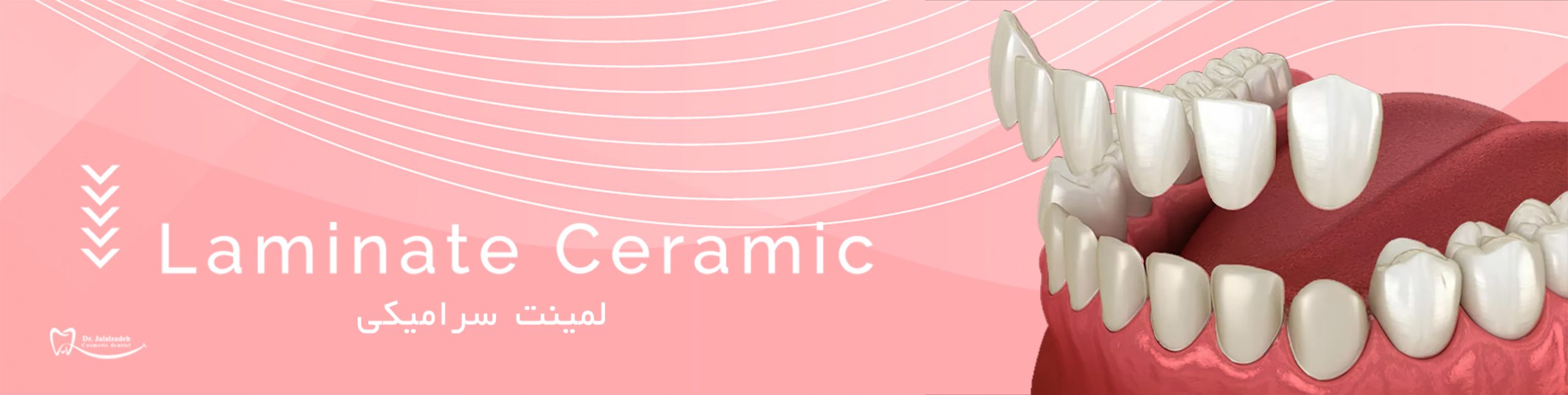 لمینیت سرامیکی