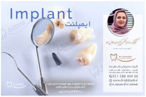 برای معاینه و مشاوره ایمپلنت باما در تماس باشید.