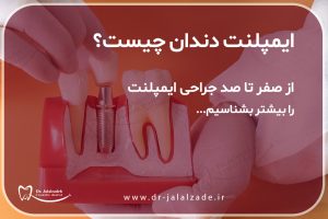 همه چیز درباره ی ایمپلنت دندان