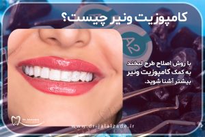 همه چیز درباره ی کامپوزیت ونیر دندان