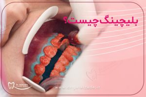 بلیچینگ چیست؟