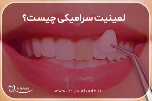 همه چیز درباره ی لمینیت سرامیکی