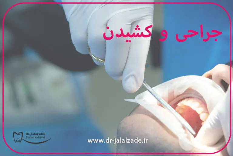 جراحی و کشیدن دندان در مشهد