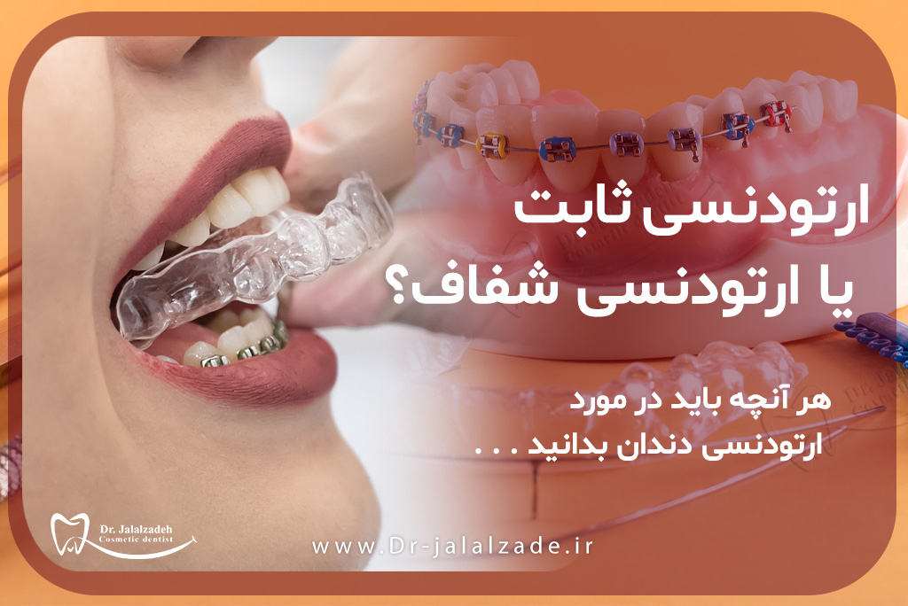ارتودنسی شفاف یا ارتودنسی ثابت