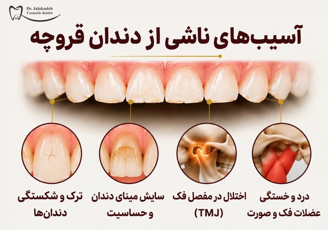 سایش و آسیب دندان بر اثر دندان قروچه