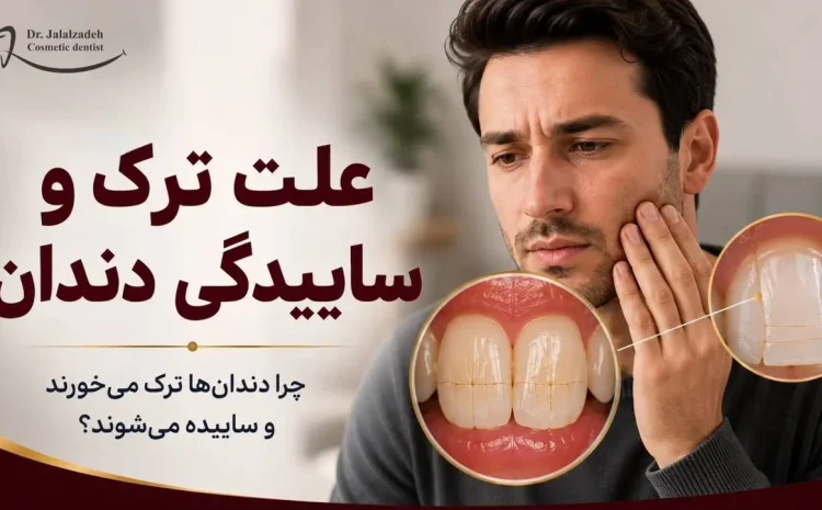  علت ترک و ساییدگی دندان چیست؟ بررسی علائم، دلایل و روش‌های درمان
