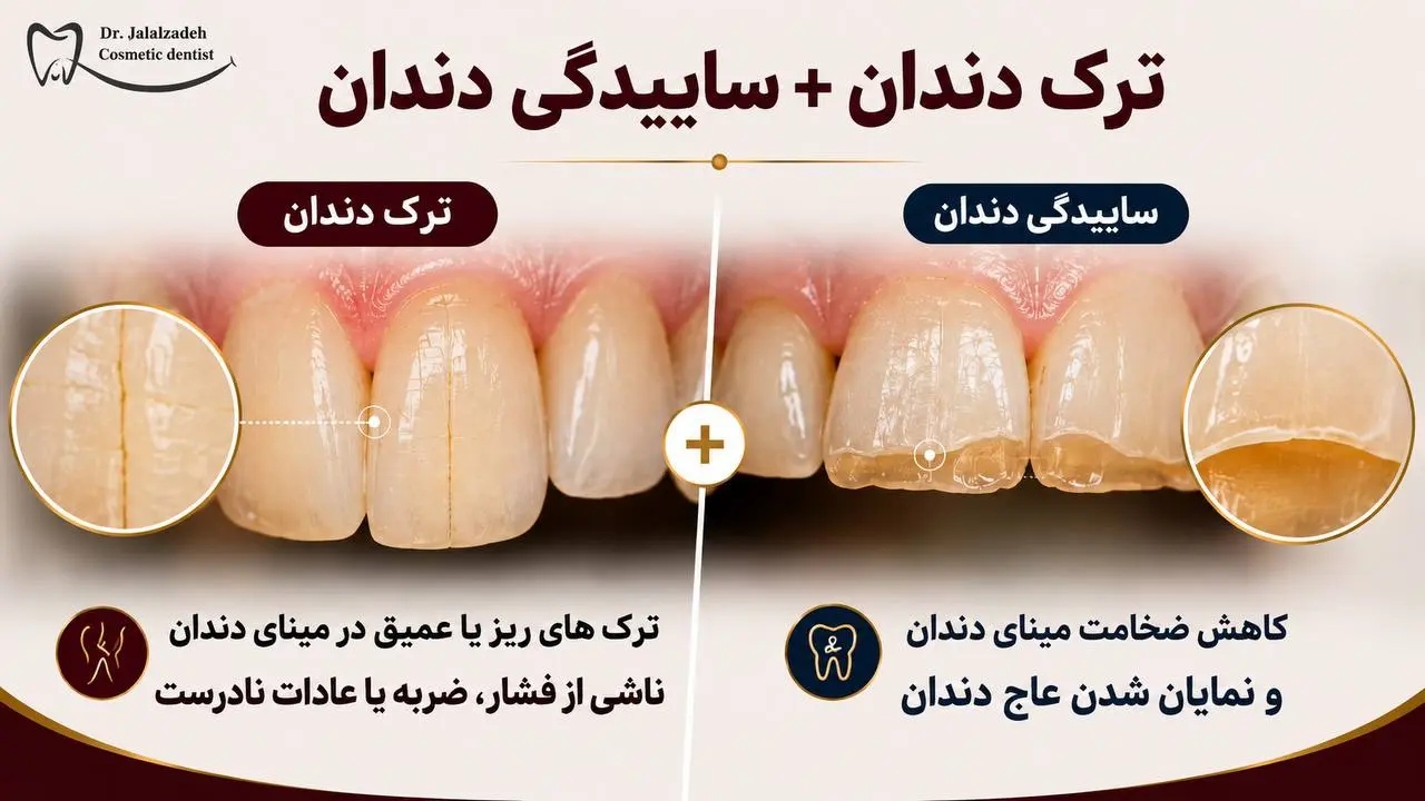 دندان قروچه و ساییدگی دندان